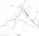 Fig. 02 - SYSTEMS AND METHODS FOR REMOVING BIOMATERIAL IMPLANTS