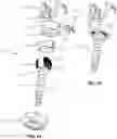 Fig. 02 - Spinal Fixation System