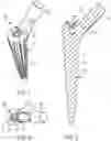Fig. 02 - ORTHOPAEDIC IMPLANT TOOL INTERFACING SOCKET