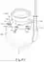 Fig. 72 - SUB-RETINAL TANGENTIAL NEEDLE CATHETER GUIDE AND INTRODUCER