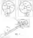 Fig. 10 - CAPSULORHEXIS APPARATUS AND METHOD