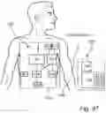 Fig. 87 - METHODS AND DEVICES FOR SECURE COMMUNICATION WITH AND OPERATION OF AN IMPLANT