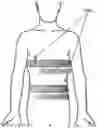 Fig. 01 - LESS INVASIVE AND IMPROVED PERIPHERAL NERVE STIMULATORS FOR OBSTRUCTIVE SLEEP APNEA AND OTHER APPLICATIONS
