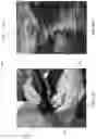 Fig. 15 - LESS INVASIVE AND IMPROVED PERIPHERAL NERVE STIMULATORS FOR OBSTRUCTIVE SLEEP APNEA AND OTHER APPLICATIONS
