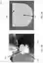 Fig. 16 - LESS INVASIVE AND IMPROVED PERIPHERAL NERVE STIMULATORS FOR OBSTRUCTIVE SLEEP APNEA AND OTHER APPLICATIONS