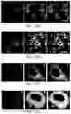 Fig. 32 - METHODS FOR THE DETECTION AND TREATMENT OF PROSTATE CANCER