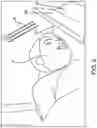 Fig. 03 - Pillow Divider Device