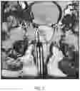 Fig. 07 - SYSTEMS AND METHODS FOR MRI-GUIDED INTERSTITIAL THERMAL THERAPY