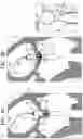 Fig. 07 - Prosthetic heart valve