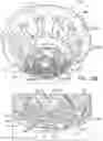 Fig. 30 - Prosthetic heart valve