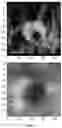 Fig. 04 - Radiogenomics for cancer subtype feature visualization