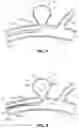 Fig. 06 - Systems and methods for treating aneurysms