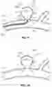 Fig. 07 - Systems and methods for treating aneurysms