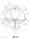 Fig. 16 - Systems and methods for treating aneurysms