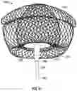 Fig. 30 - Systems and methods for treating aneurysms