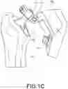 Fig. 04 - DEVICES AND METHODS FOR PREVENTING INTRAOPERATIVE FRACTURES DURING ARTHROPLASTY