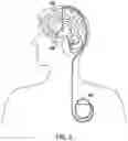 Fig. 04 - METHOD AND APPARATUS FOR DITHERING NEUROSTIMULATION PARAMETERS