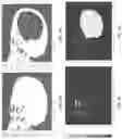 Fig. 09 - METHOD OF DESIGNING PATIENT-SPECIFIC CRANIOPLASTY IMPLANTS