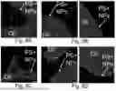Fig. 14 - CHARGED SURFACTANT PARTICLES AND BRUSH POLYMERIC PARTICLES, METHODS OF MAKING SAME, AND USES THEREOF