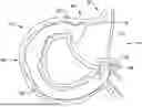 Fig. 01 - Tethers for Dynamic Gastric Bypass Device