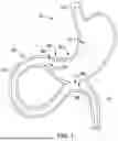 Fig. 02 - Tethers for Dynamic Gastric Bypass Device