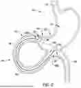 Fig. 03 - Tethers for Dynamic Gastric Bypass Device