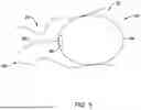 Fig. 05 - Tethers for Dynamic Gastric Bypass Device