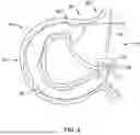 Fig. 06 - Tethers for Dynamic Gastric Bypass Device