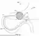 Fig. 14 - Tethers for Dynamic Gastric Bypass Device