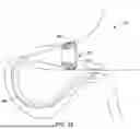 Fig. 15 - Tethers for Dynamic Gastric Bypass Device