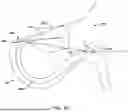 Fig. 17 - Tethers for Dynamic Gastric Bypass Device