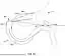 Fig. 18 - Tethers for Dynamic Gastric Bypass Device