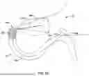 Fig. 19 - Tethers for Dynamic Gastric Bypass Device