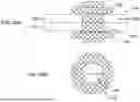 Fig. 24 - Tethers for Dynamic Gastric Bypass Device