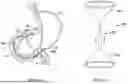 Fig. 34 - Tethers for Dynamic Gastric Bypass Device