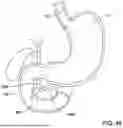 Fig. 37 - Tethers for Dynamic Gastric Bypass Device