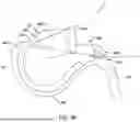 Fig. 42 - Tethers for Dynamic Gastric Bypass Device