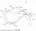 Fig. 43 - Tethers for Dynamic Gastric Bypass Device