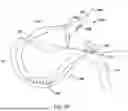 Fig. 45 - Tethers for Dynamic Gastric Bypass Device