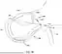 Fig. 46 - Tethers for Dynamic Gastric Bypass Device