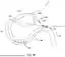 Fig. 47 - Tethers for Dynamic Gastric Bypass Device