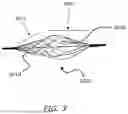 Fig. 04 - INTRALUMINAL DEVICE