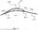 Fig. 05 - INTRALUMINAL DEVICE