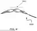 Fig. 07 - INTRALUMINAL DEVICE
