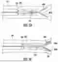 Fig. 06 - Mechanical Thrombectomy Device for Capture and Removal of Occlusions