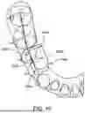 Fig. 13 - SYSTEMS AND METHODS FOR OCCLUSAL MANDIBULAR ADVANCEMENT BLOCK PLACEMENT