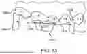 Fig. 16 - SYSTEMS AND METHODS FOR OCCLUSAL MANDIBULAR ADVANCEMENT BLOCK PLACEMENT