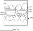 Fig. 19 - SYSTEMS AND METHODS FOR OCCLUSAL MANDIBULAR ADVANCEMENT BLOCK PLACEMENT
