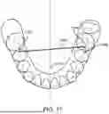 Fig. 20 - SYSTEMS AND METHODS FOR OCCLUSAL MANDIBULAR ADVANCEMENT BLOCK PLACEMENT