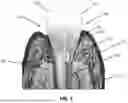 Fig. 02 - INTEGRATED TISSUE MANAGEMENT SOLUTIONS IN ORTHODONTIC ALIGNERS